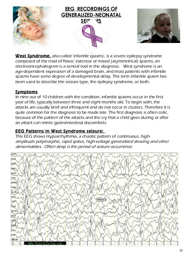 facial spasm during eeg Anal douche anal swirl